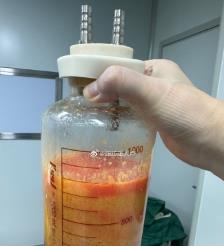 阿里水动力吸脂手术要做多久？